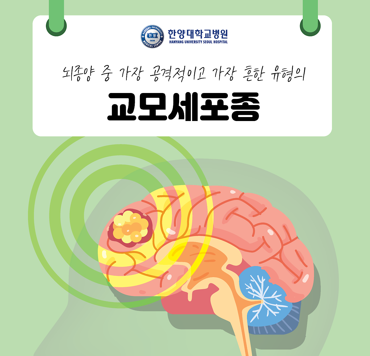 뇌종양 중 가장 공격적이고 가장 흔한 유형의, 교모세포종